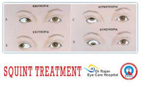 Best Squint eye Center in Delhi